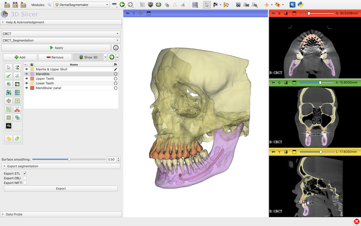 CBCT 3D render with segmented anatomy